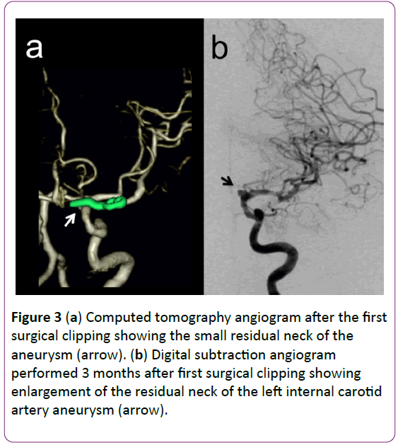 jneuro-Computed-tomography-angiogram