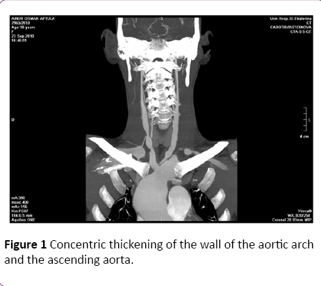 jneuro-Concentric-aortic-arch