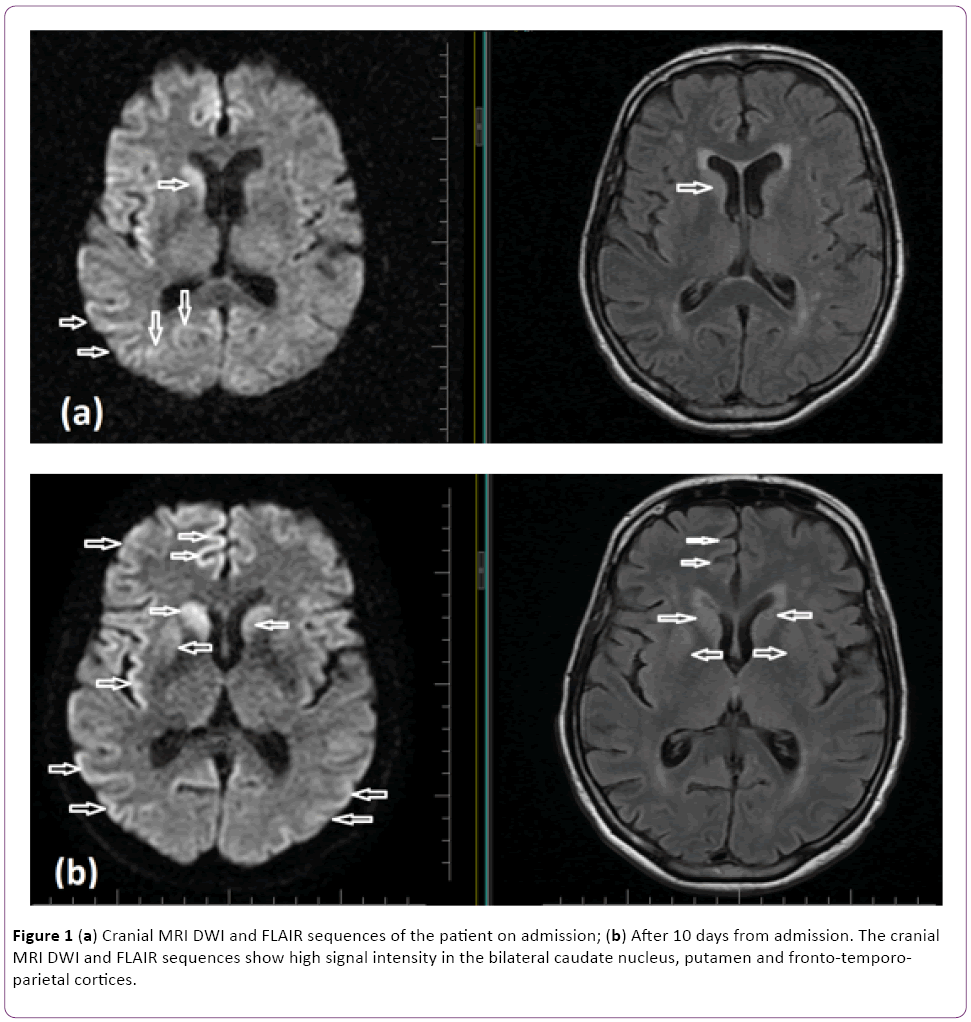 jneuro-Cranial-MRI-DWI