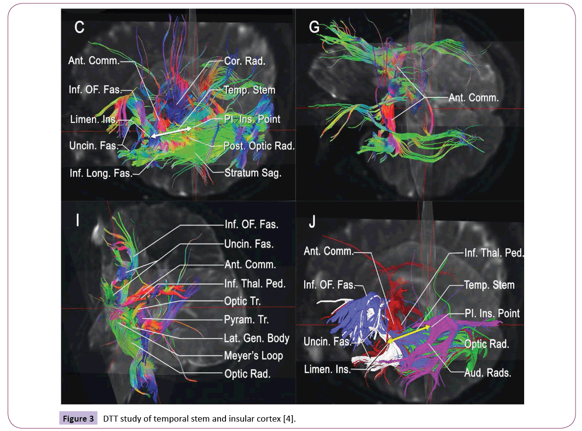 jneuro-DTT-study