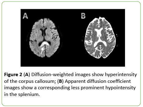 jneuro-Diffusion-weighted