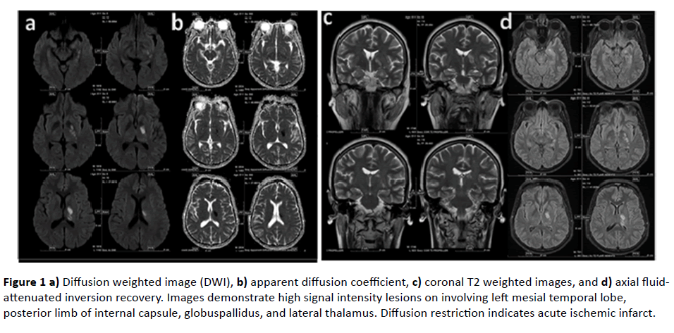 jneuro-Diffusion-weighted-image