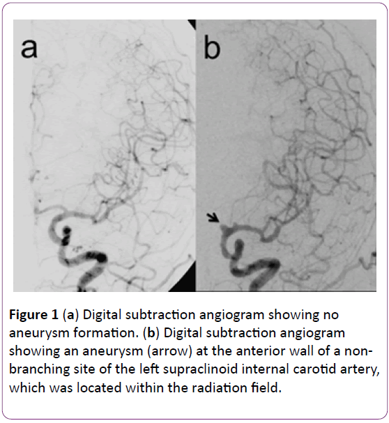 jneuro-Digital-subtraction-angiogram