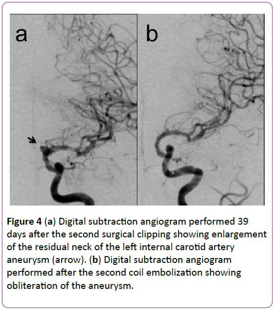 jneuro-Digital-subtraction-angiogram