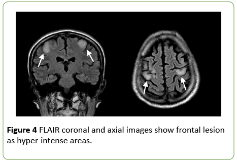 jneuro-FLAIR-coronal