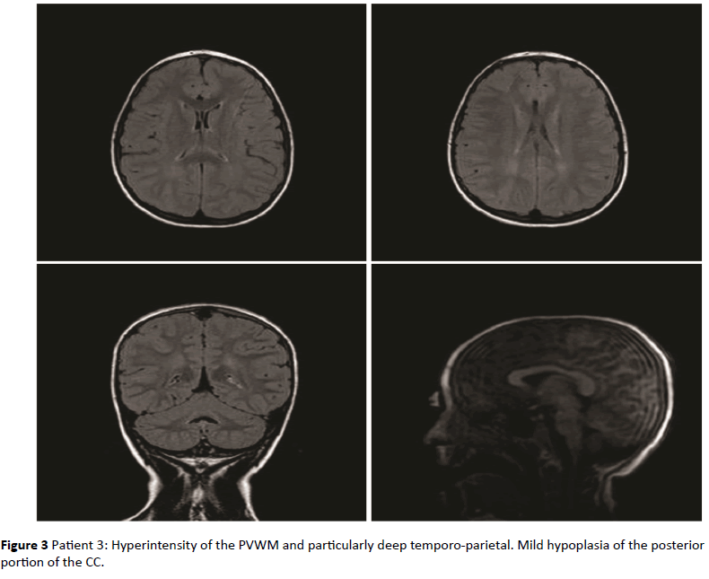 jneuro-Hyperintensity-temporo-parietal-hypoplasia