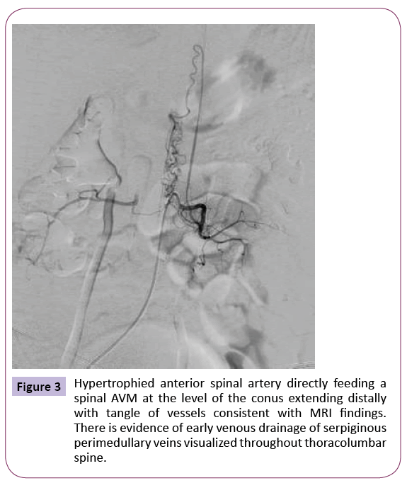 jneuro-Hypertrophied-anterior