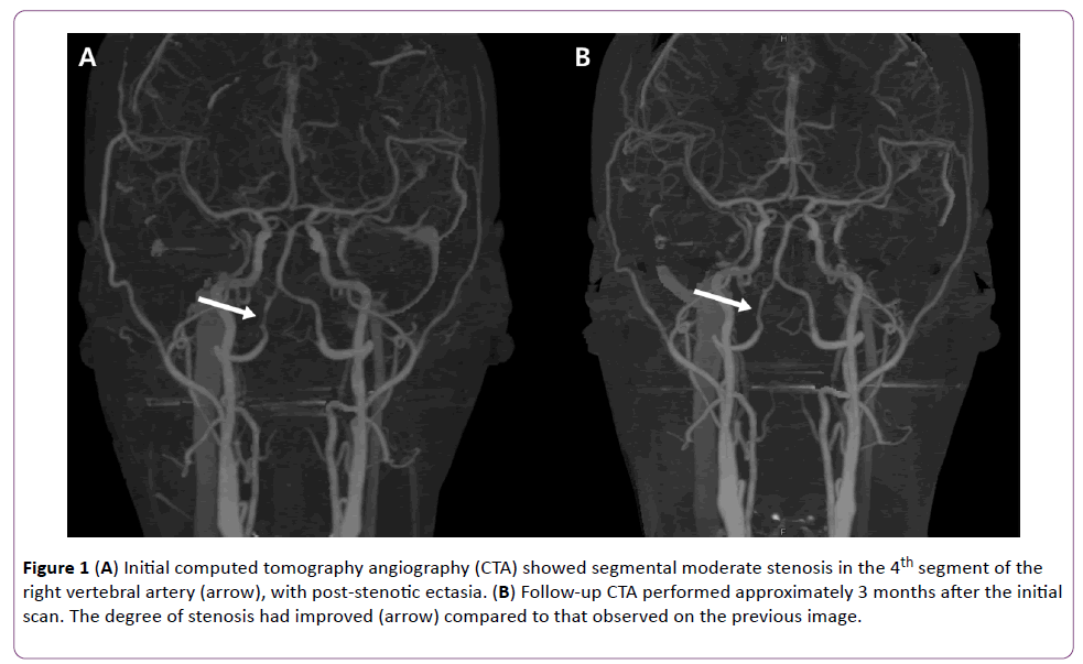 jneuro-Initial-computed-tomography-angiography