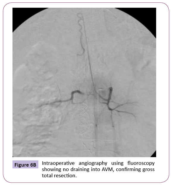 jneuro-Intraoperative-angiography