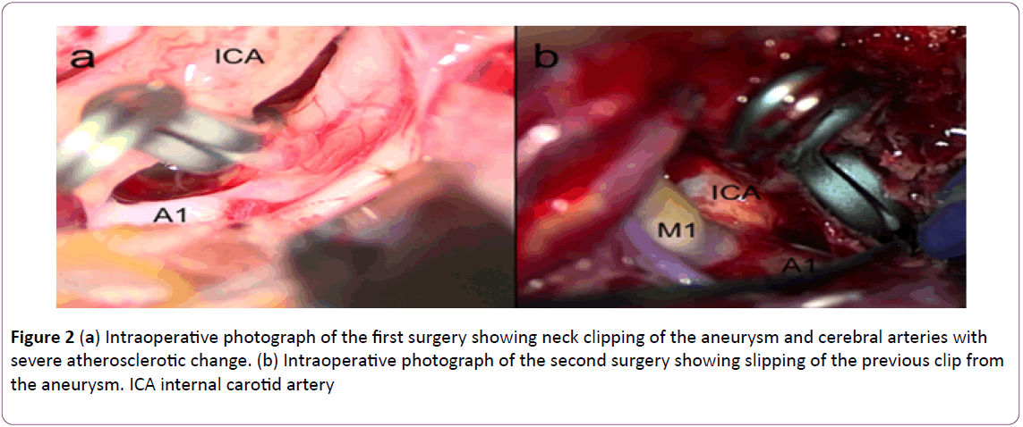 jneuro-Intraoperative-photograph-surgery
