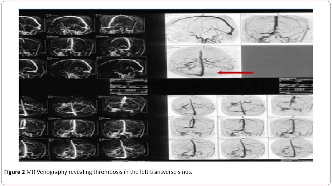 jneuro-MR-Venography-revealing