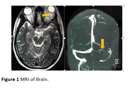 jneuro-MRI-Brain