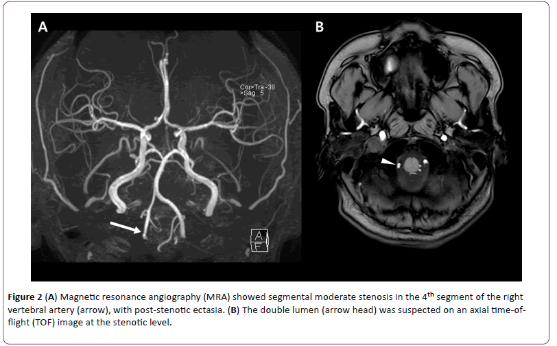 jneuro-Magnetic-resonance-angiography