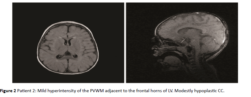 jneuro-Mild-hyperintensity-frontal-horns