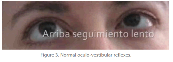 jneuro-Normal-oculo-vestibular