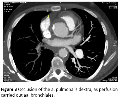 jneuro-Occlusion-pulmonalis-perfusion