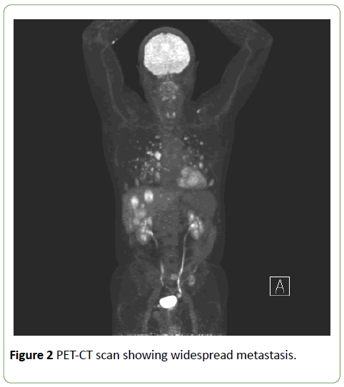jneuro-PET-CT-scan-widespread-metastasis