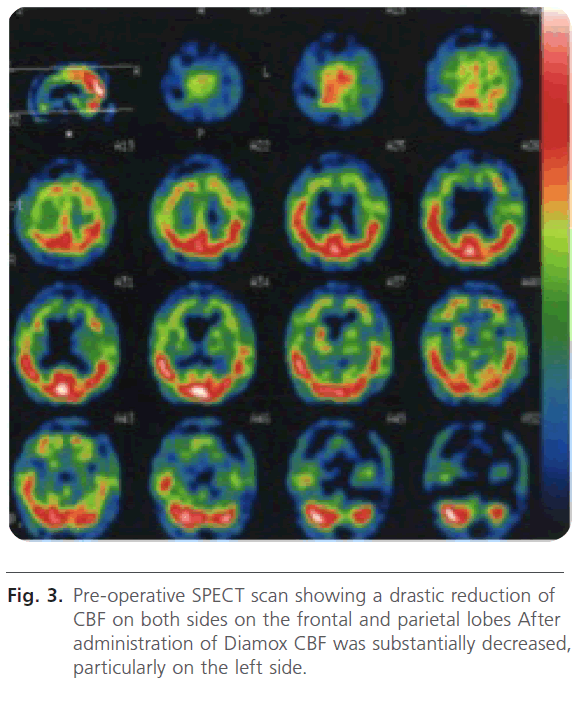 jneuro-Pre-operative-SPECT