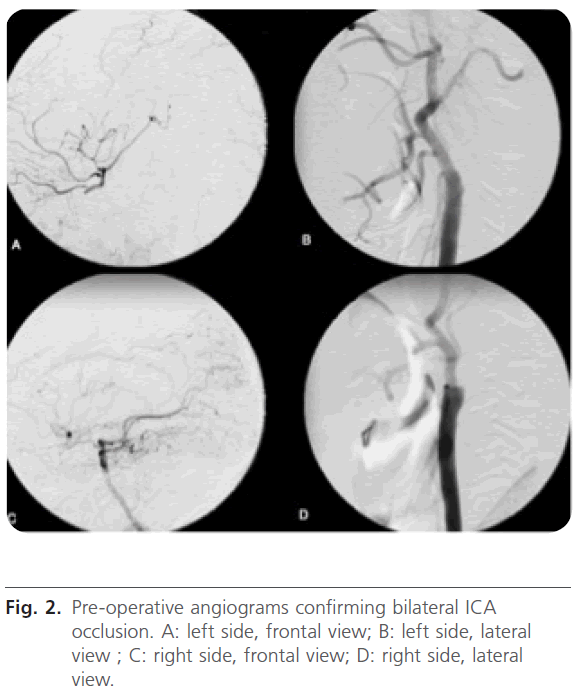 jneuro-Pre-operative-angiograms