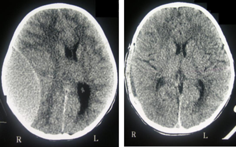 Pre-operative-neurosurgical-evacuation