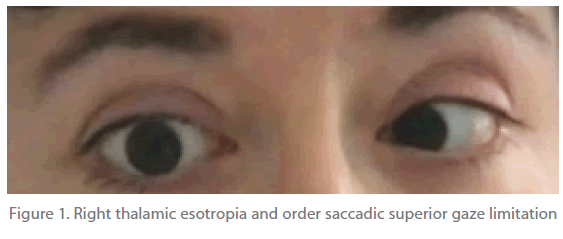 jneuro-Right-thalamic-esotropia