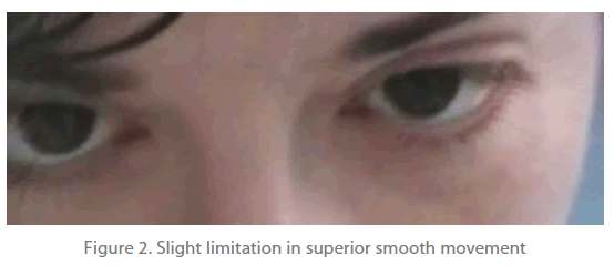 jneuro-Slight-limitation-superior