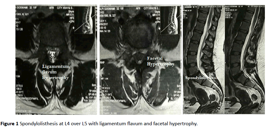 jneuro-Spondylolisthesis