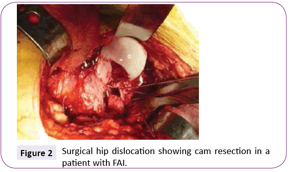 jneuro-Surgical-hip