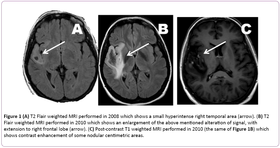 jneuro-T2-Flair-weighted-MRI