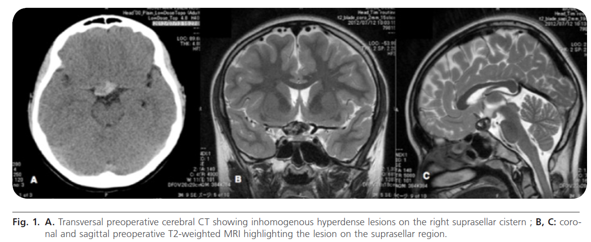 jneuro-Transversal-preoperative