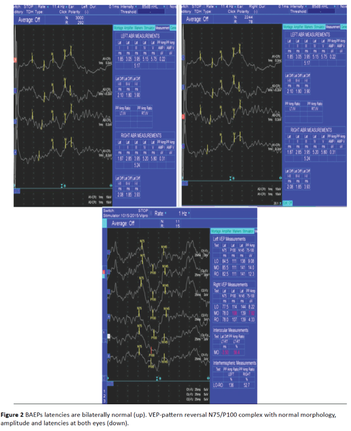 jneuro-VEP-pattern