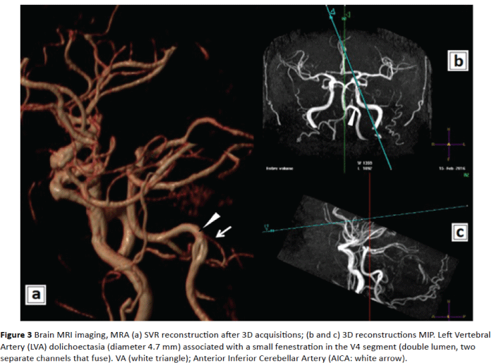 jneuro-Vertebral-Artery