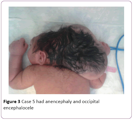 jneuro-anencephaly-occipital