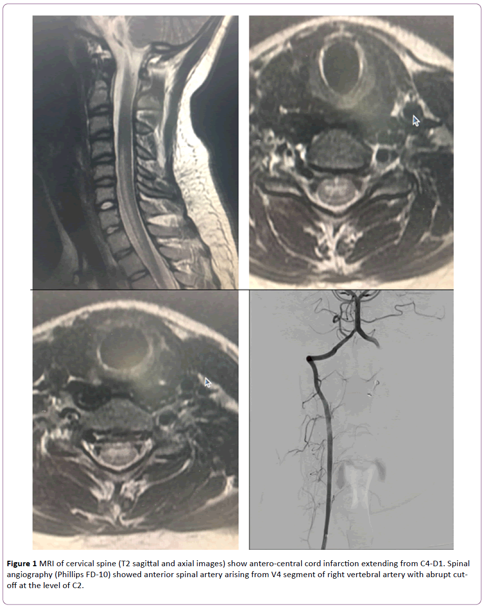 jneuro-antero-central-cord-infarction