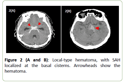 jneuro-cisterns