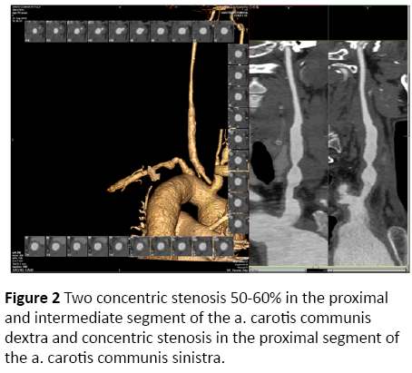 jneuro-concentric-stenosis-proximal