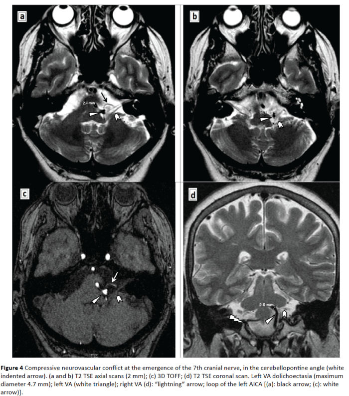 jneuro-Vertebral-Artery