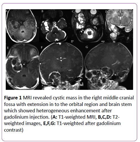 jneuro-cystic-mass