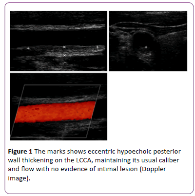 jneuro-eccentric-hypoechoic-posterior