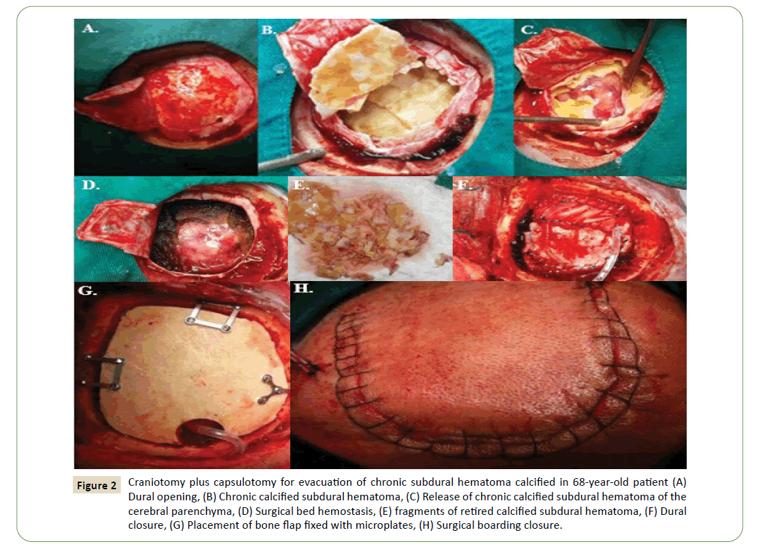 jneuro-hematoma