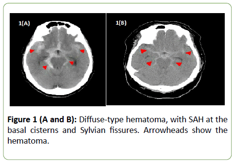 jneuro-hematoma