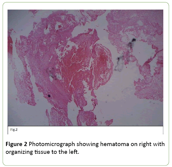 jneuro-hematoma-right