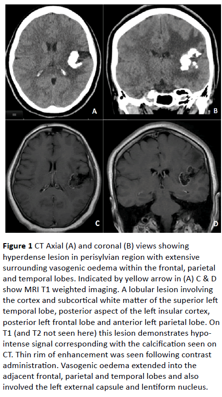 hyperdense-lesion-perisylvian