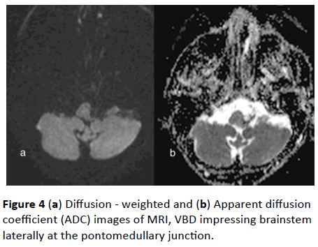 jneuro-impressing-brainstem