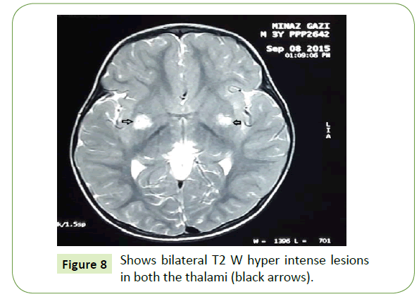 jneuro-intense-lesions