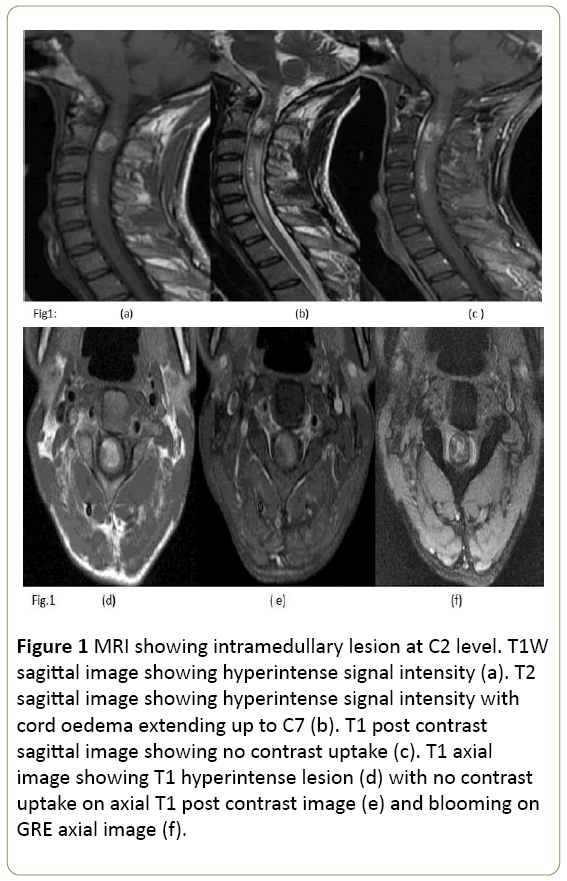 jneuro-intramedullary-lesion