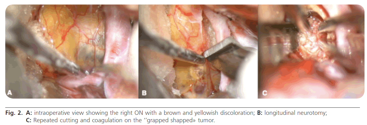 jneuro-intraoperative-view