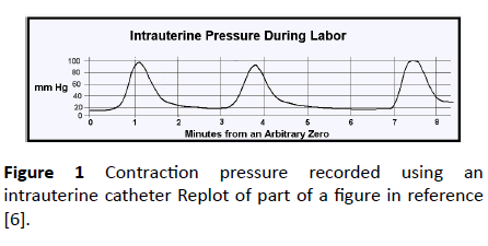 jneuro-intrauterine-catheter