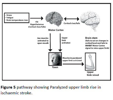 jneuro-ischaemic-stroke