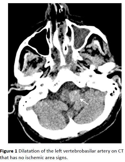 jneuro-ischemic-area